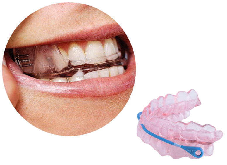 Mandibular Advancement Splint Wikipedia, 40 OFF